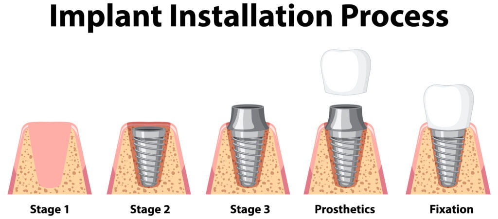 Dental Implants Turkey