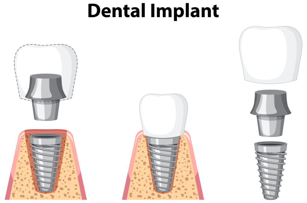 Dental Implants