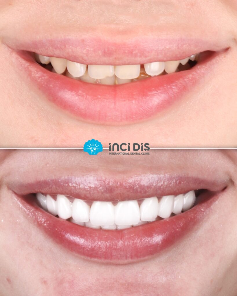 Zirconia Crown Before and After 