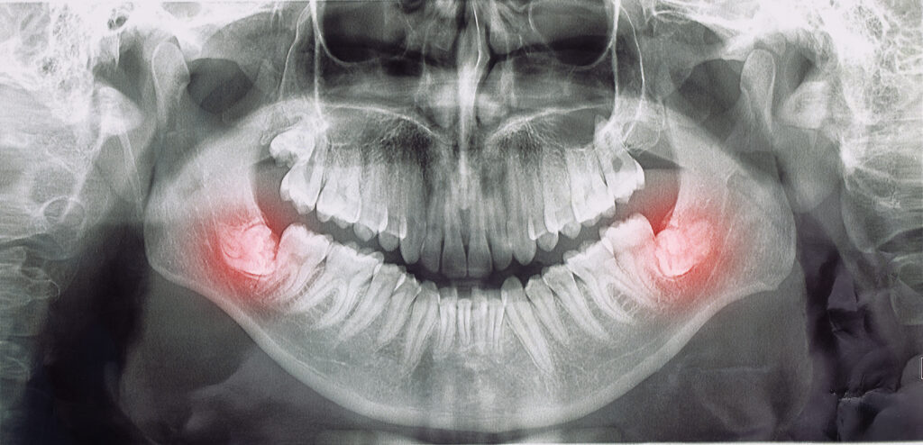 impacted teeth - ınci dis dental clinic turkey