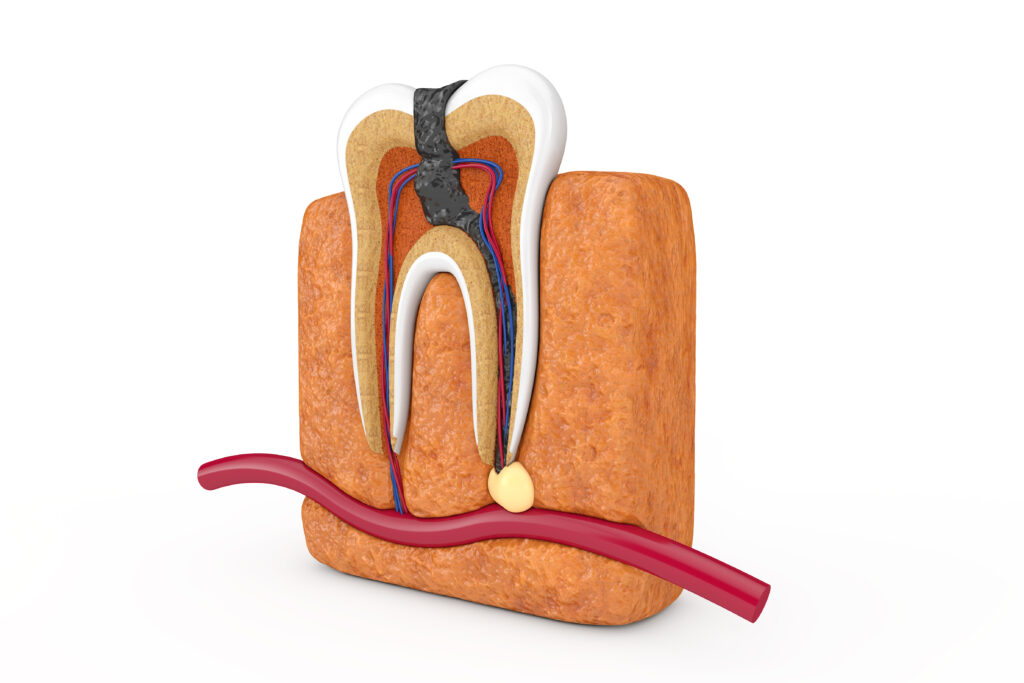 How Many Sessions Does Root Canal Treatment Take in Turkey?